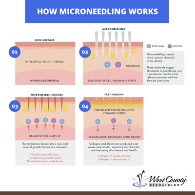 Trigger natural skin-improving physiological mechanisms with microneedling at at Chesterfield's West County Dermatology. Trigger natural skin-improving physiological mechanisms with microneedling at at Chesterfield's West County Dermatology.