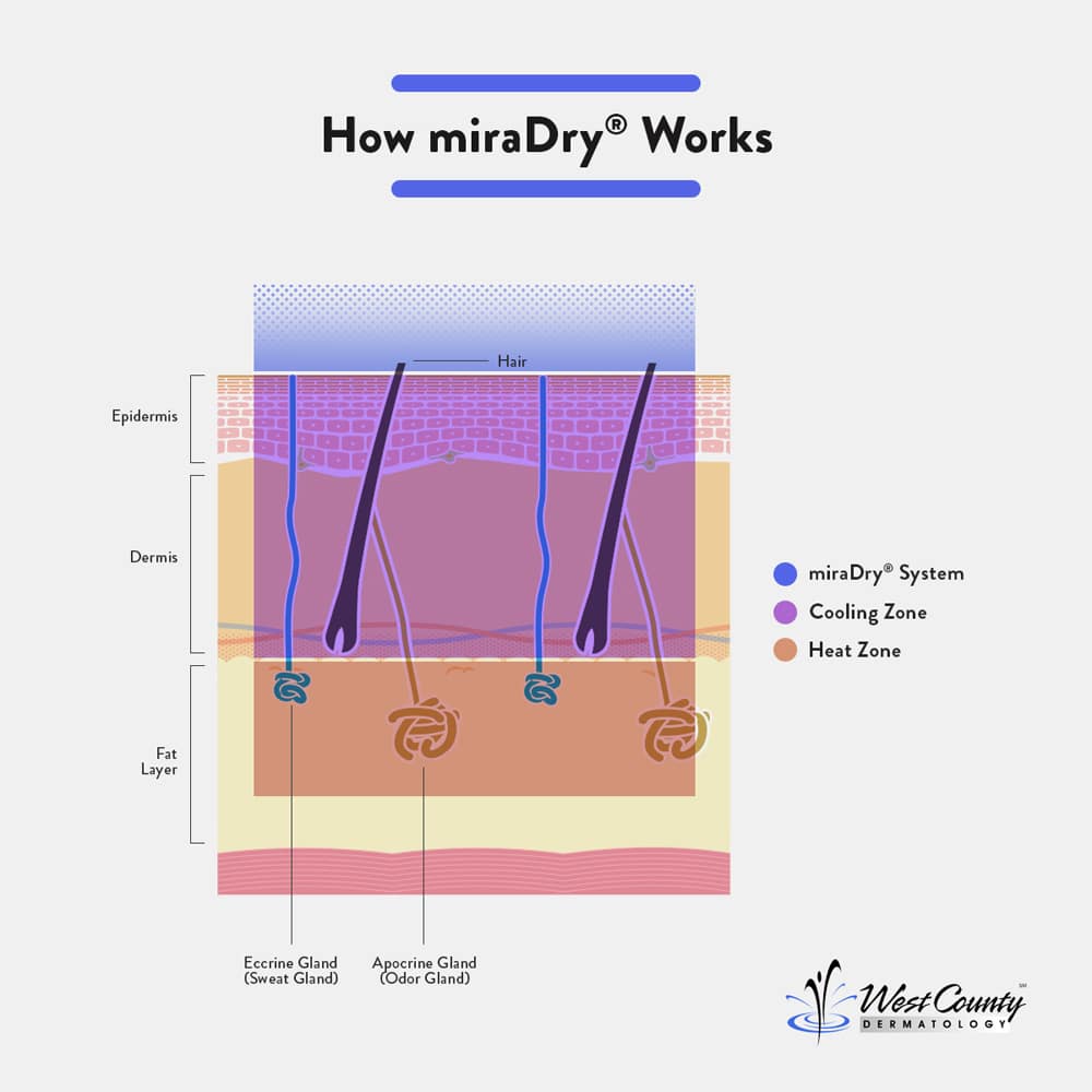 Although miraDry® uses powerful heat to shut down sweat and odor glands at Chesterfield's West County Dermatology, the technology keeps layers above cool to prevent damage. Although miraDry® uses powerful heat to shut down sweat and odor glands at Chesterfield's West County Dermatology, the technology keeps layers above cool to prevent damage.